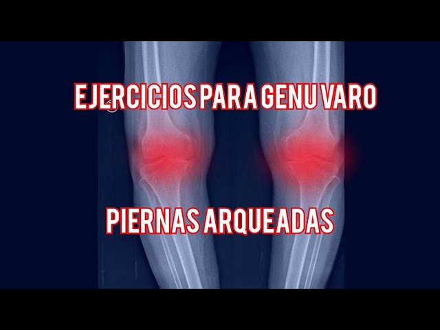 aparatos para enderezar las piernas arqueadas