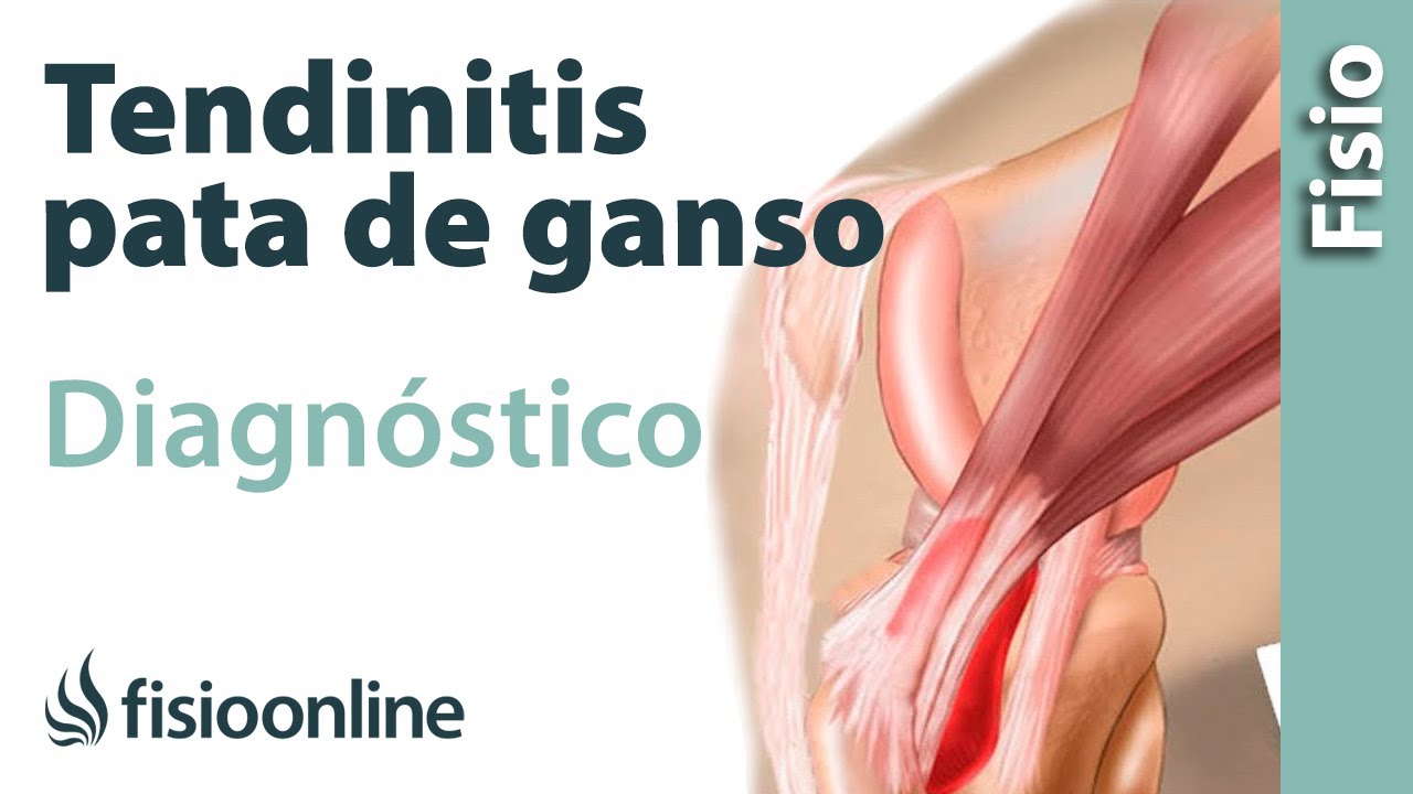 bursitis de la pata de ganso sintomas