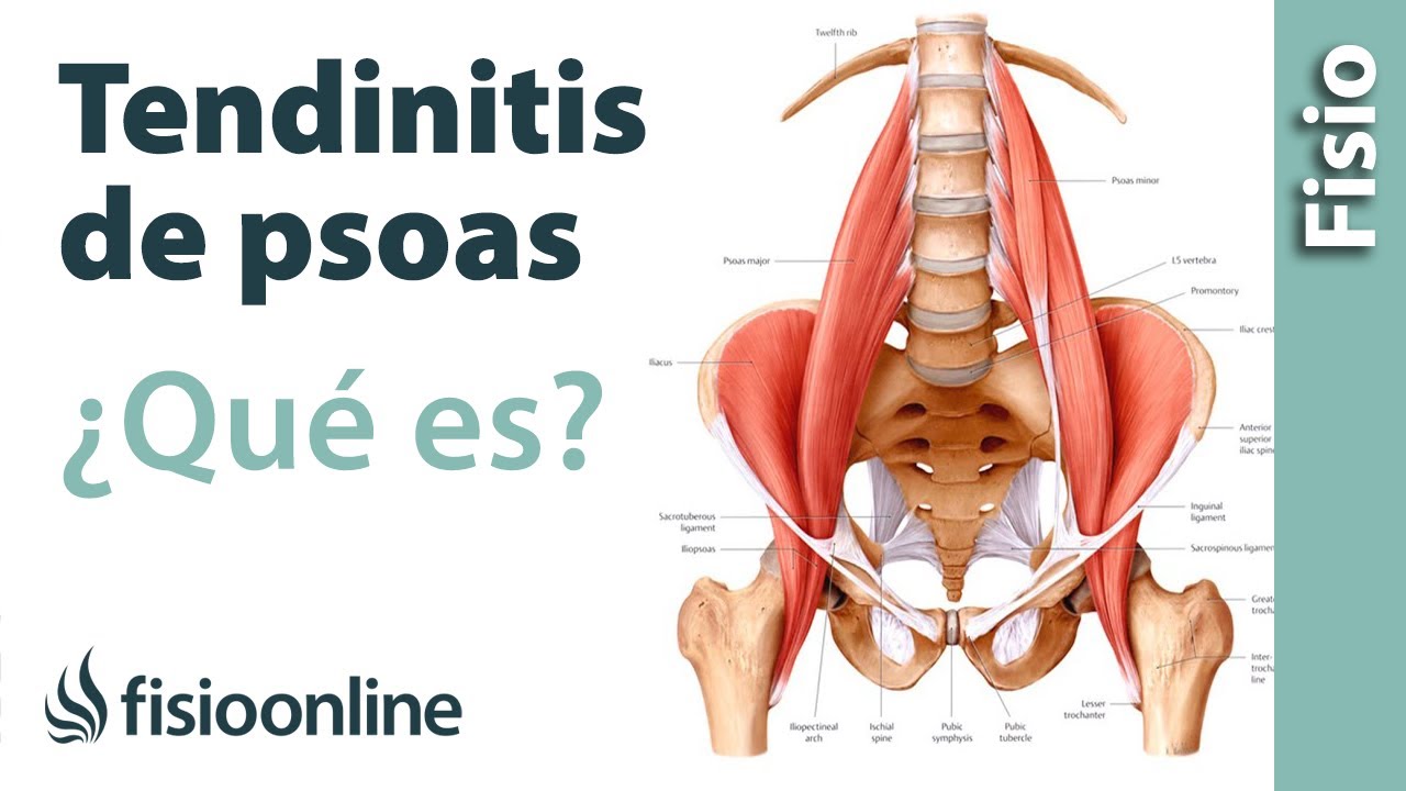 dolor en el psoas al caminar