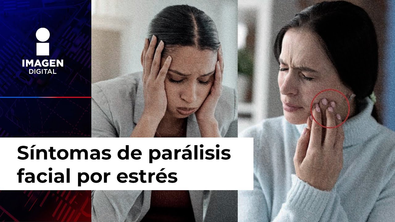 el estres puede causar paralisis facial