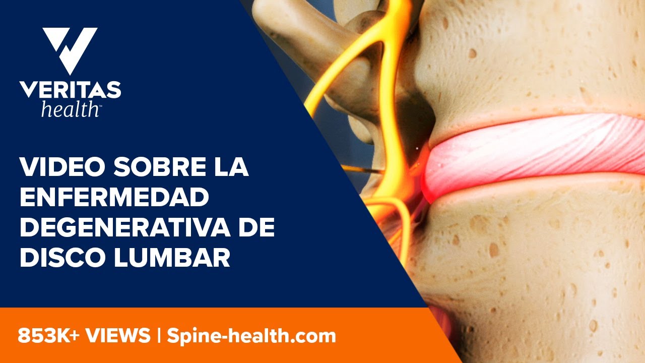 enfermedad degenerativa de disco lumbar sintomas