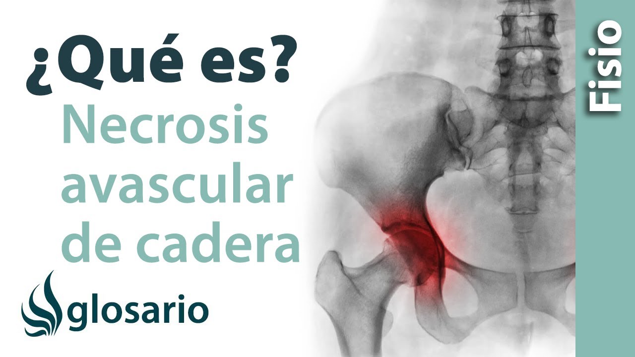 necrosis de cadera como se cura