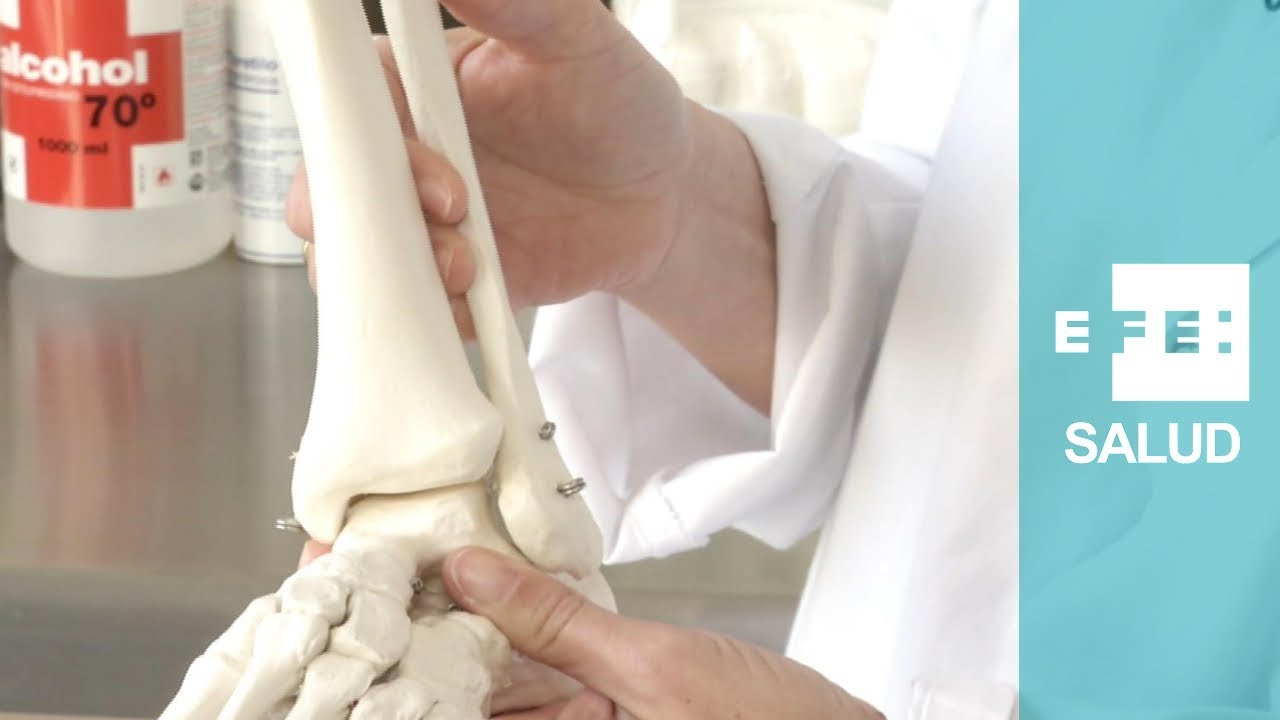 operar o no una fractura maleolo