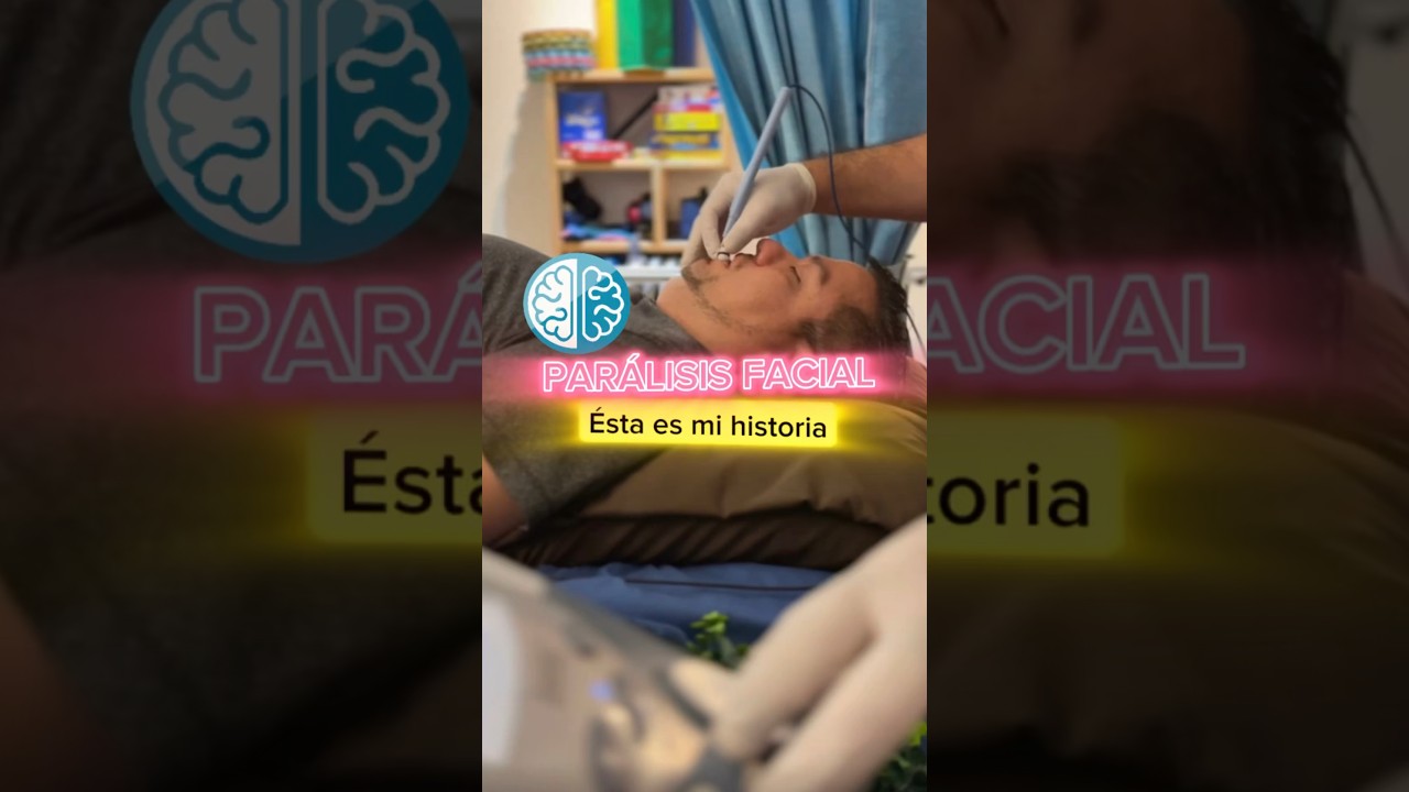 paralisis facial periferica tiempo de recuperacion