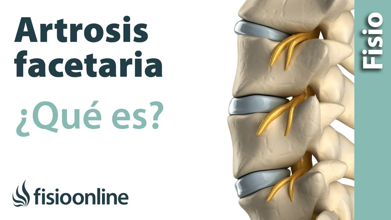 que es artrosis facetaria l5 s1