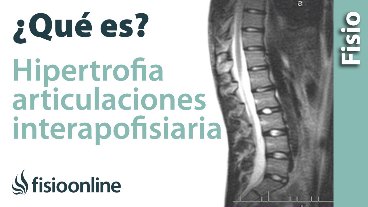 que es hipertrofia facetaria l4 l5