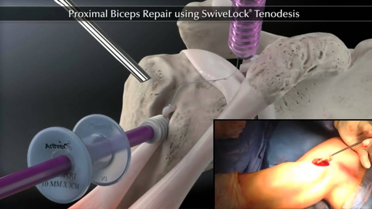 rotura de la porcion larga del biceps