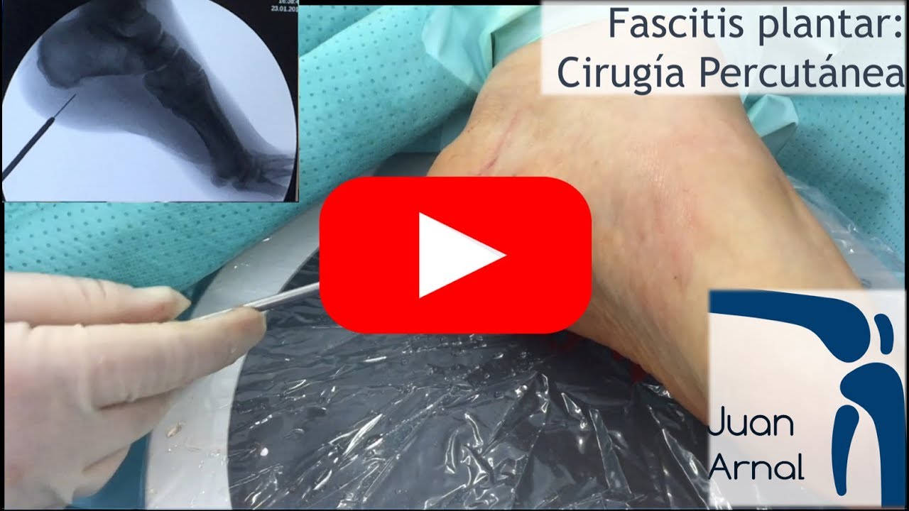 tiempo de recuperacion de operacion de fascitis plantar