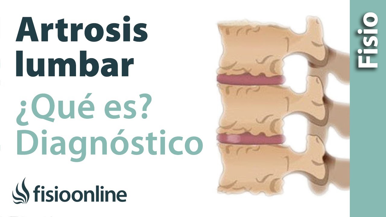 artrosis en la columna vertebral sintomas