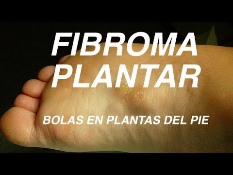 bolita en la planta del pie izquierdo