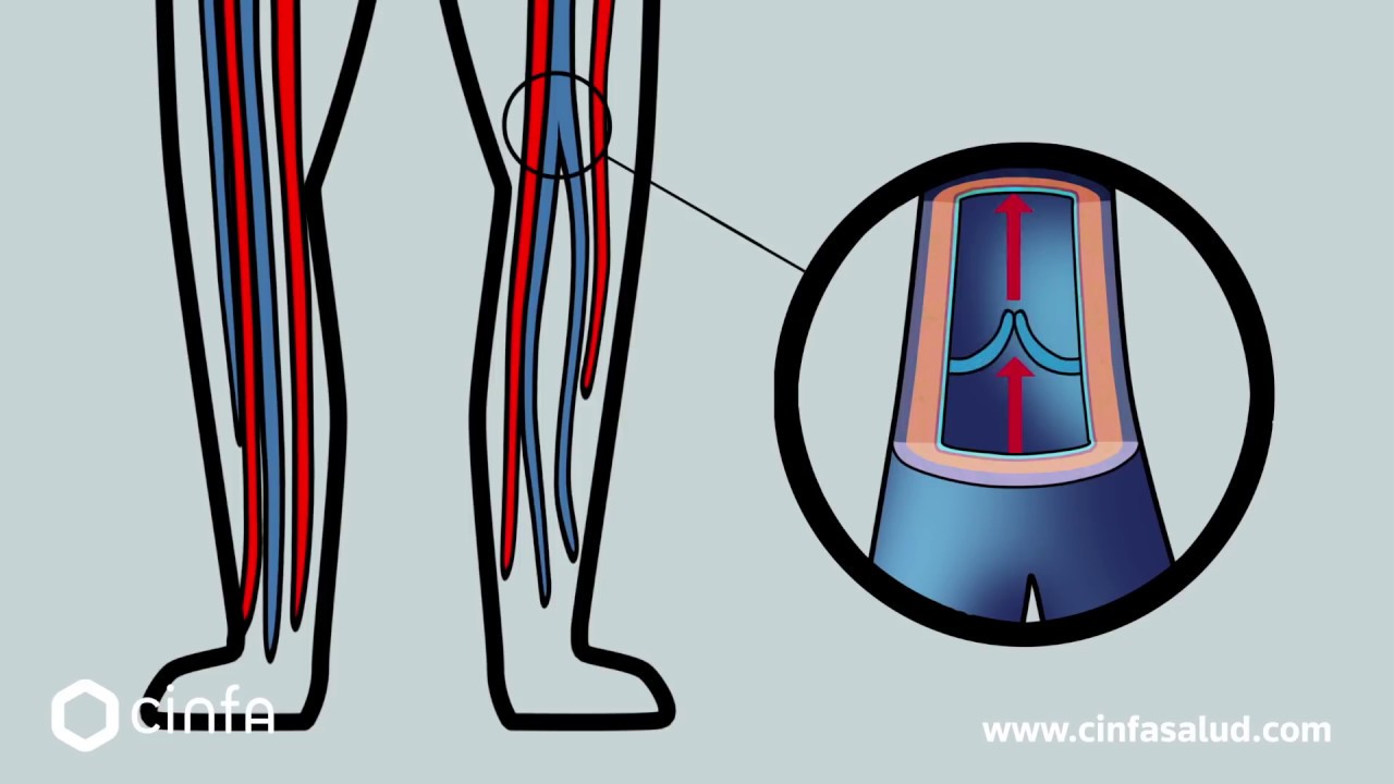 como aliviar la pesadez de las piernas