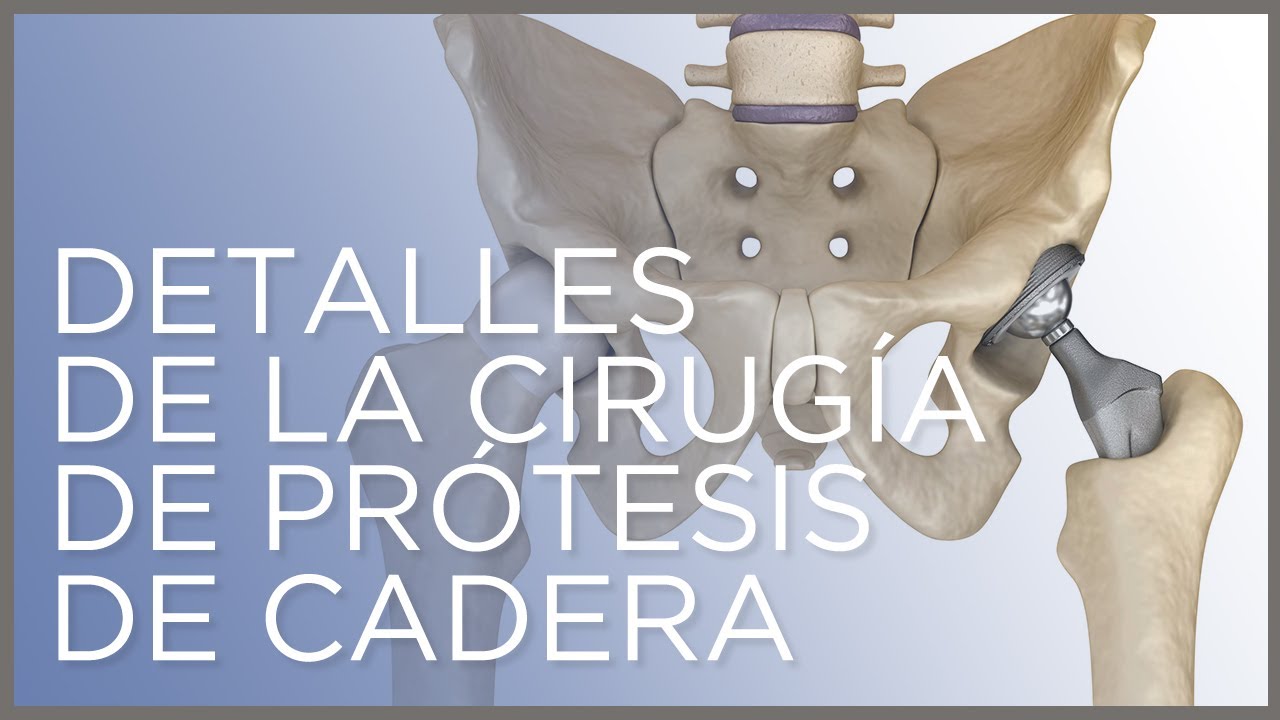 como es una protesis de cadera