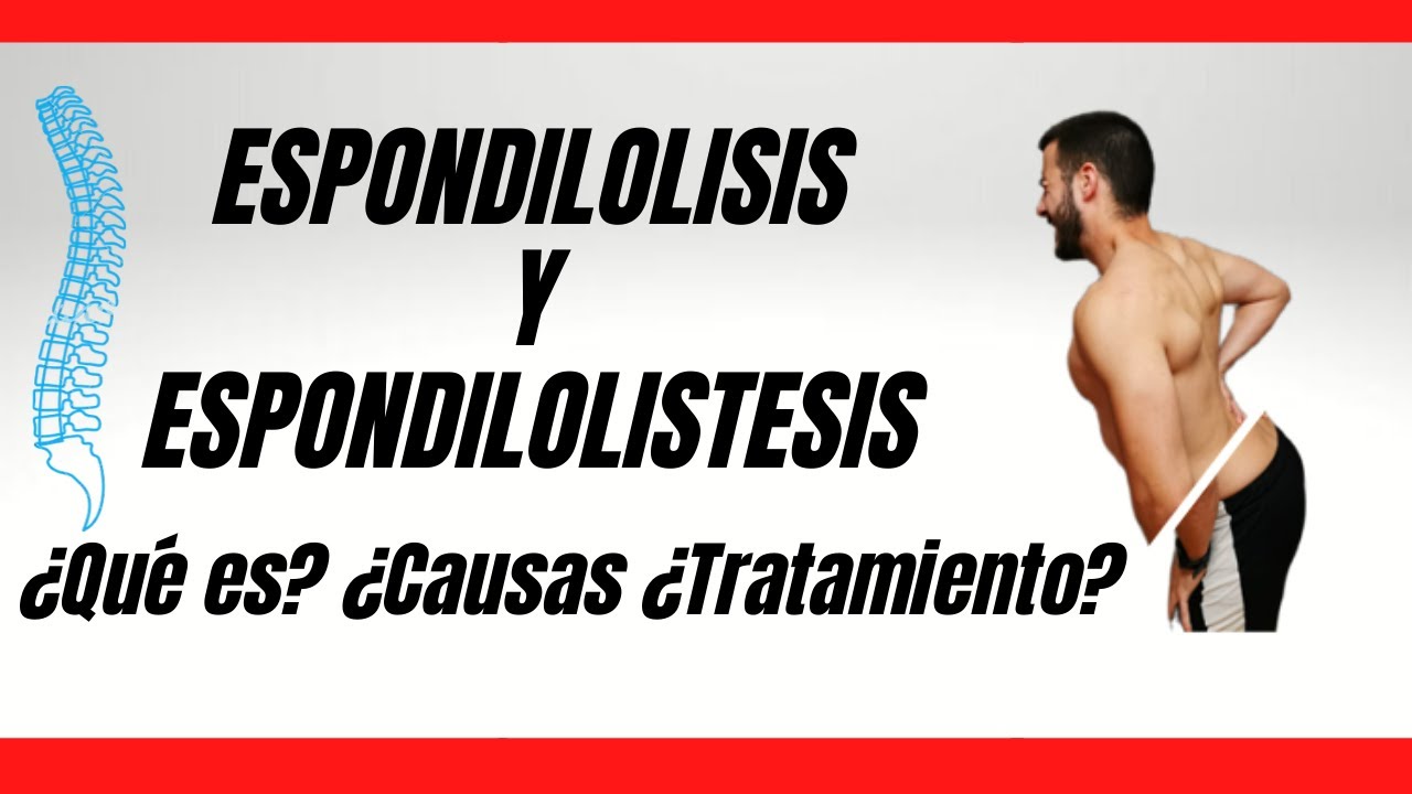 como se cura la espondilosis lumbar