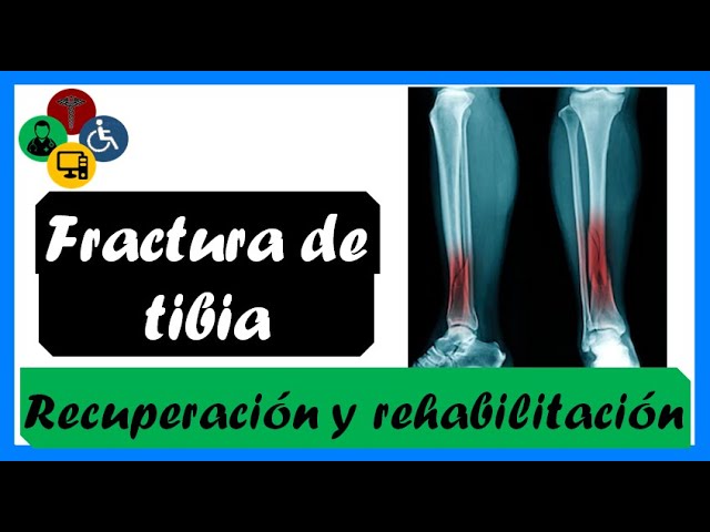 cuanto tarda en soldar un hueso tibia