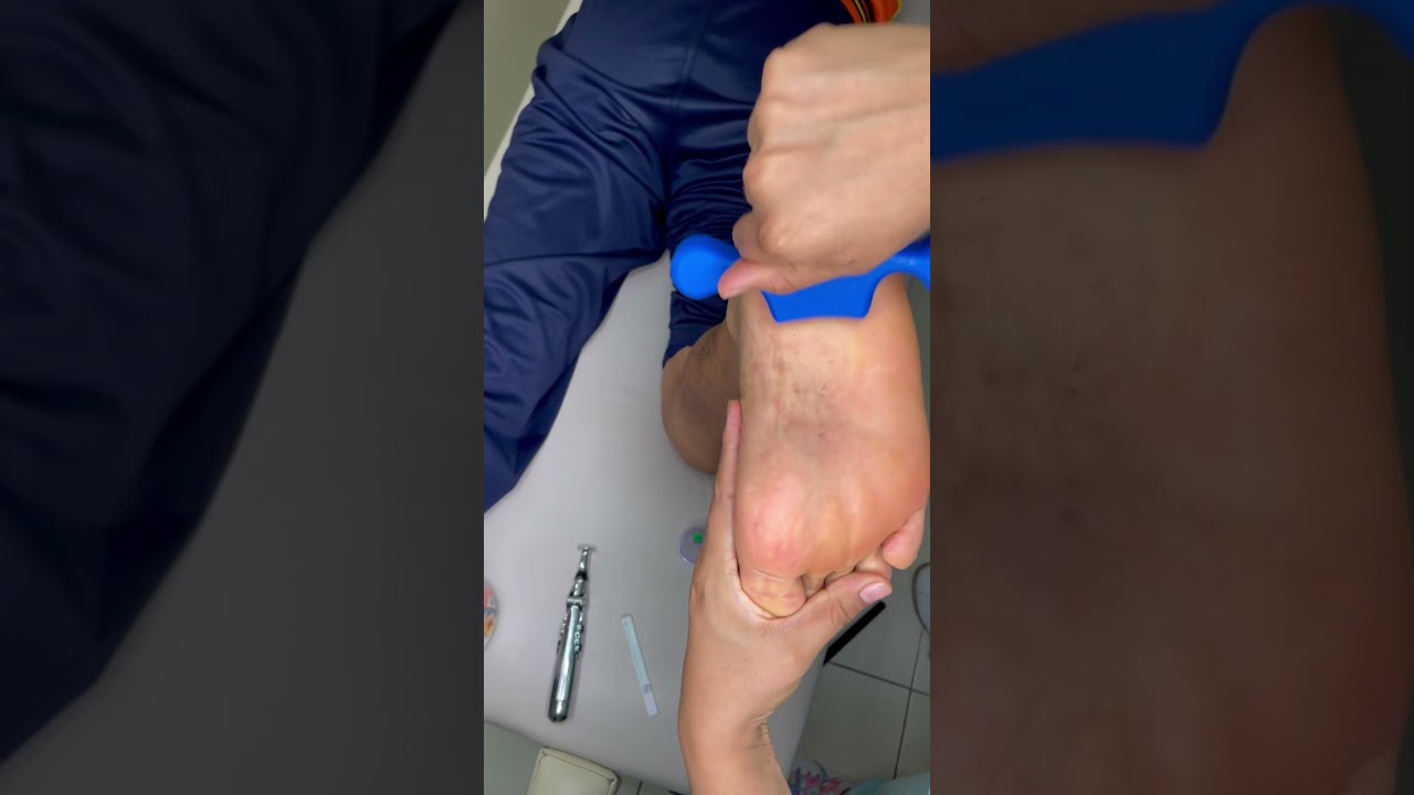 hematoma en el talon del pie
