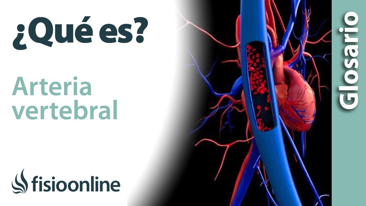 hipoplasia de arteria vertebral izquierda sintomas