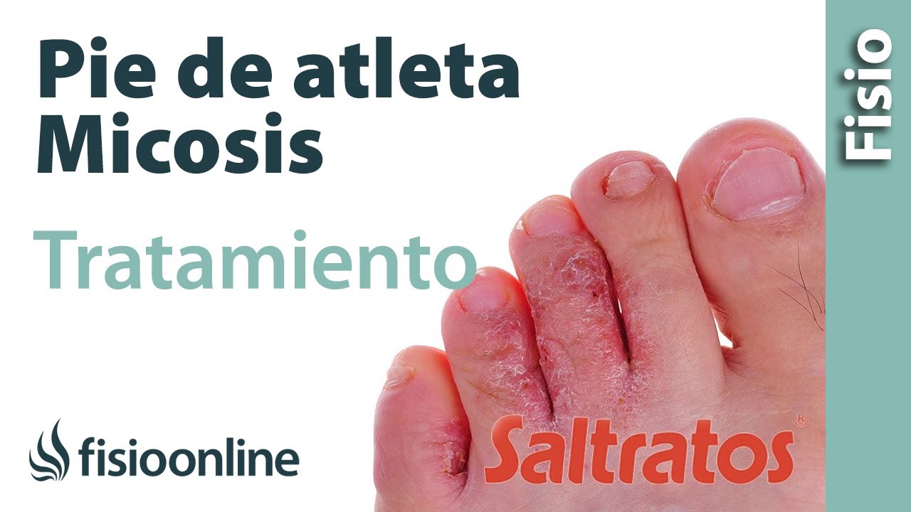 hongos en los pies causas y tratamiento