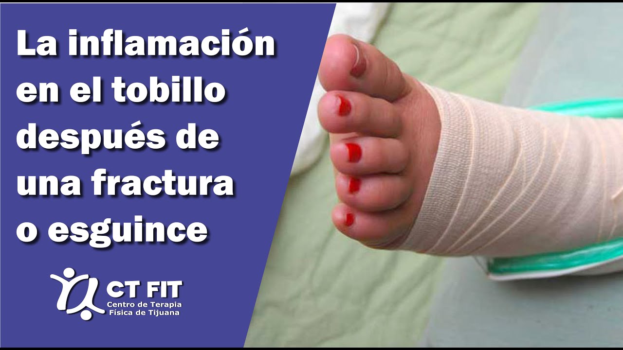 liquido en el tobillo despues de un esguince