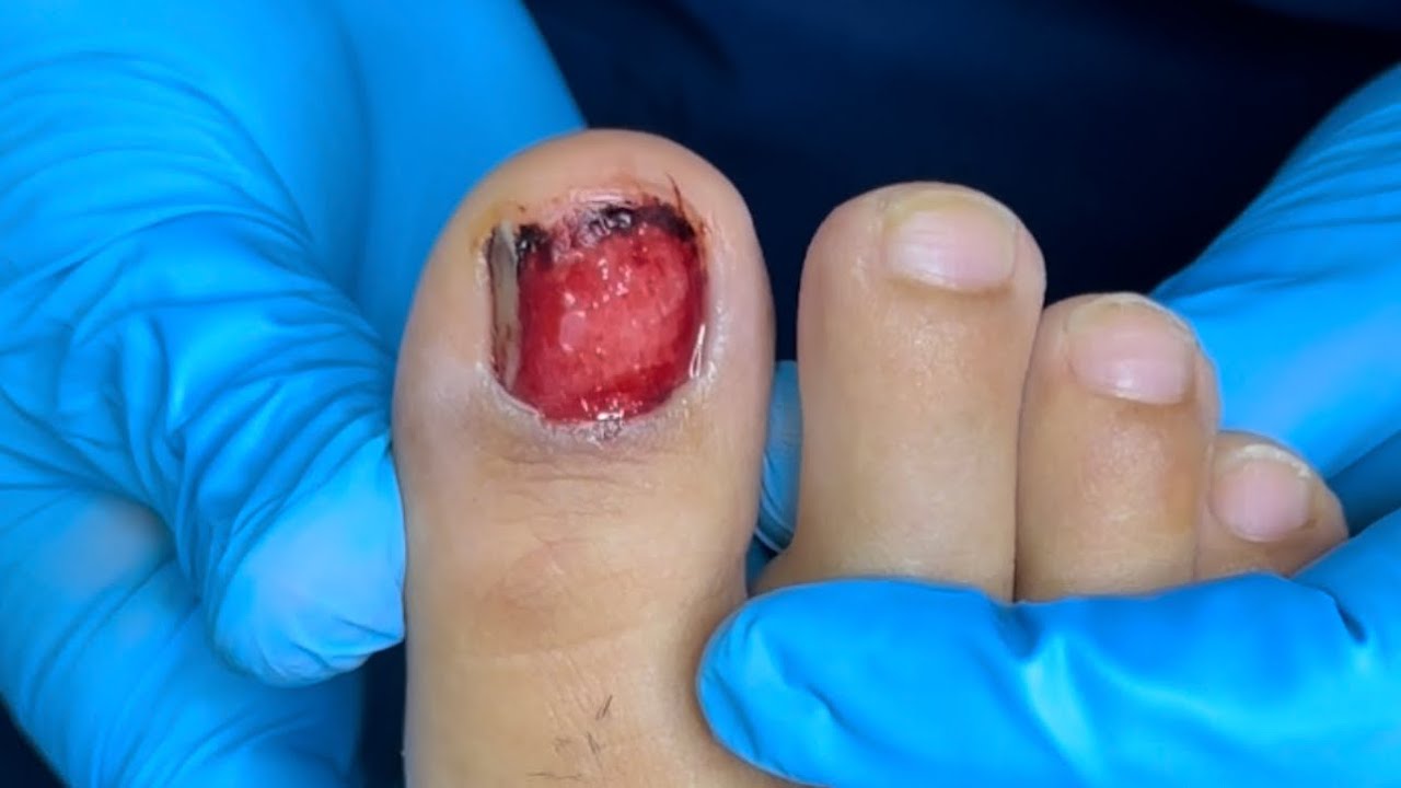 me han quitado la uña del dedo gordo del pie