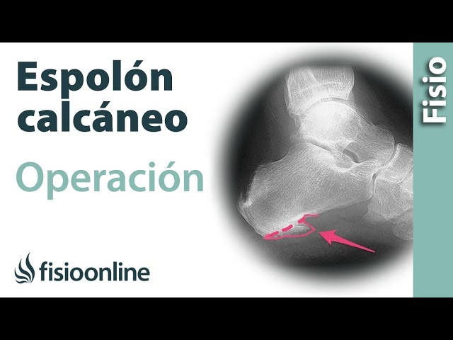 operacion de espolon calcaneo es peligroso