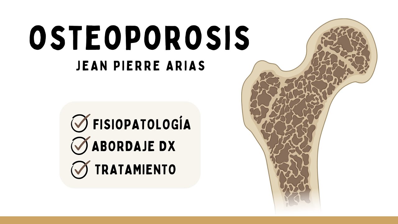 osteoporosis fisiopatología diagnóstico prevención y tratamiento