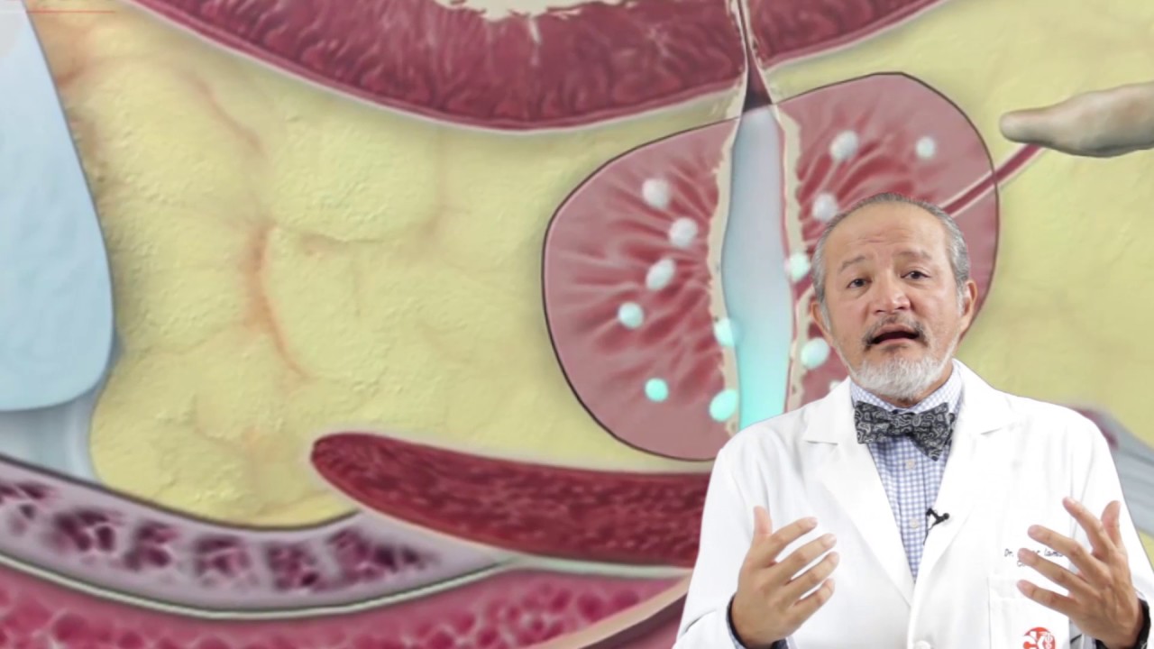 prostatitis y calcificaciones en la prostata
