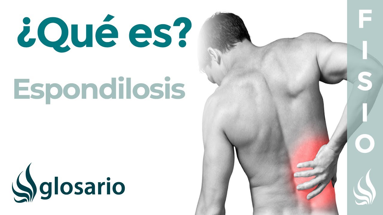 que es espondiloartrosis de columna lumbar