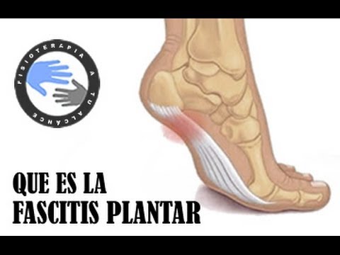 que es la fascitis plantar y como tratarla