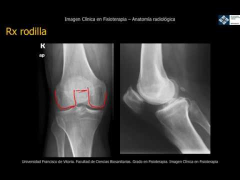 radiografia de rodilla con ligamentos rotos