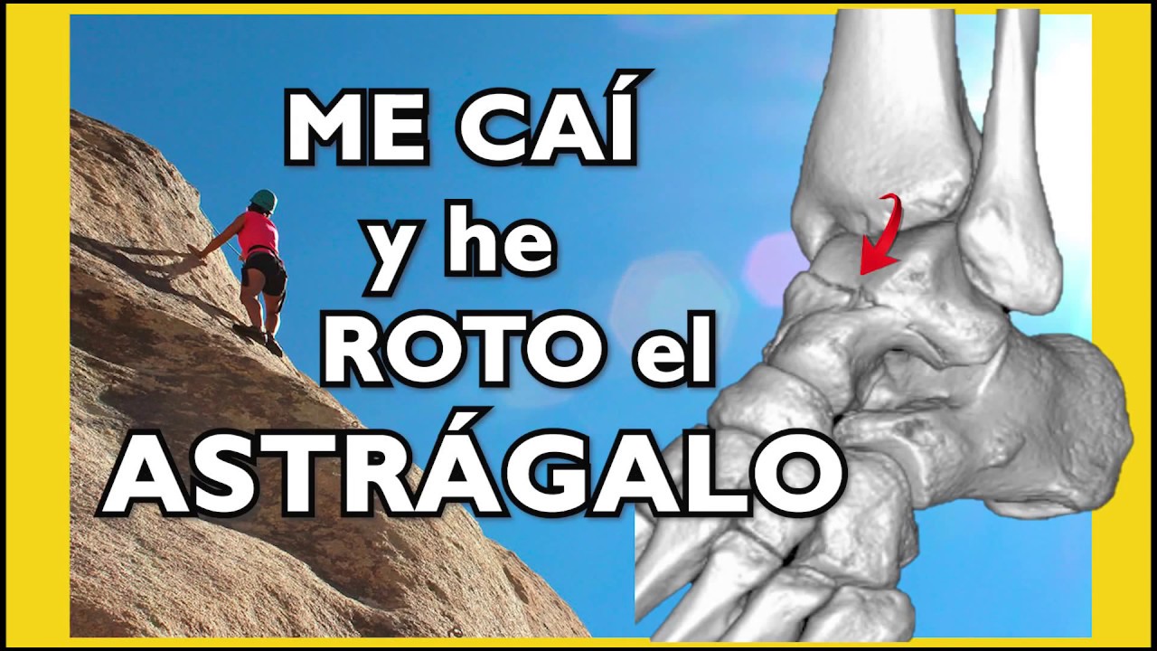 se puede caminar con el astragalo roto