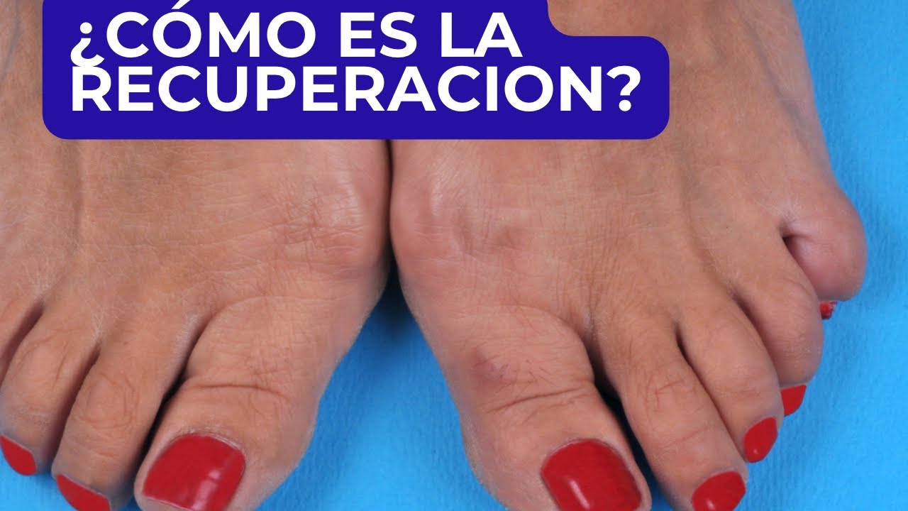 tiempo de recuperacion de cirugia de juanetes