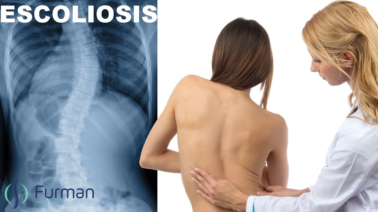 tratamiento de la escoliosis en adolescentes