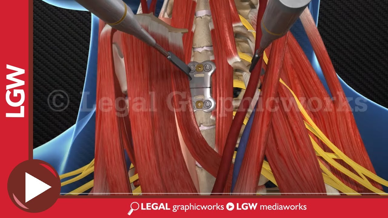 uncoartrosis c5 c6 y c6 c7