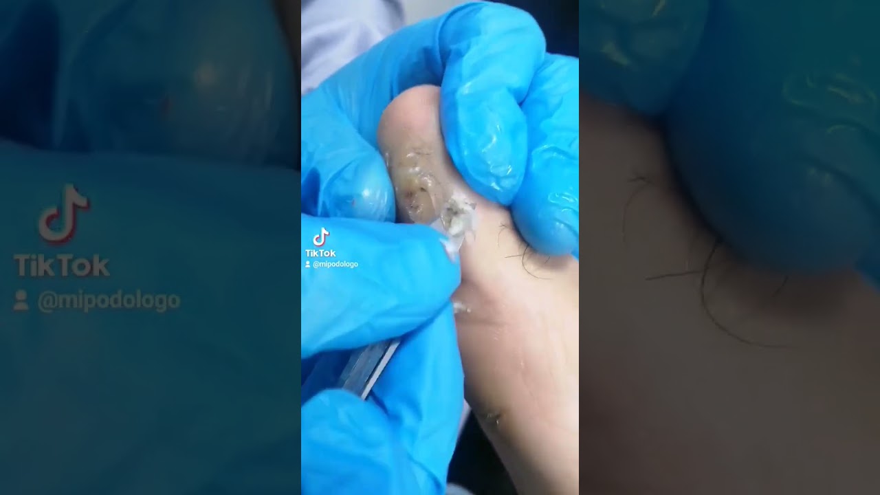 callo con punto en el centro