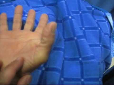 cirugia de dedo pulgar en gatillo