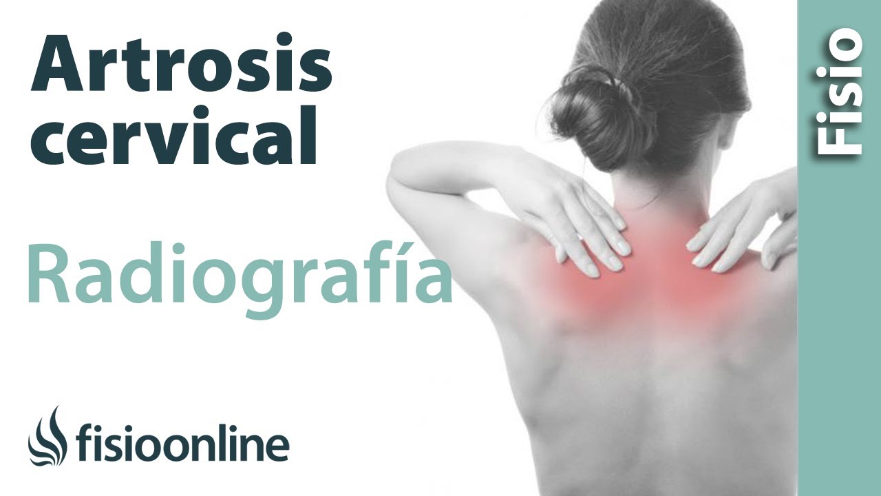 cuáles son los síntomas de artrosis cervical