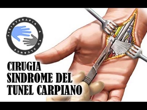 cuando operar el sindrome del tunel carpiano