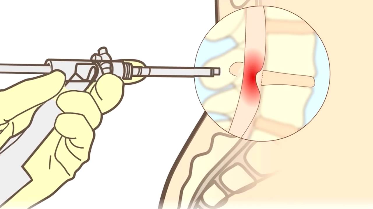 cuanto dura una operacion de hernia discal