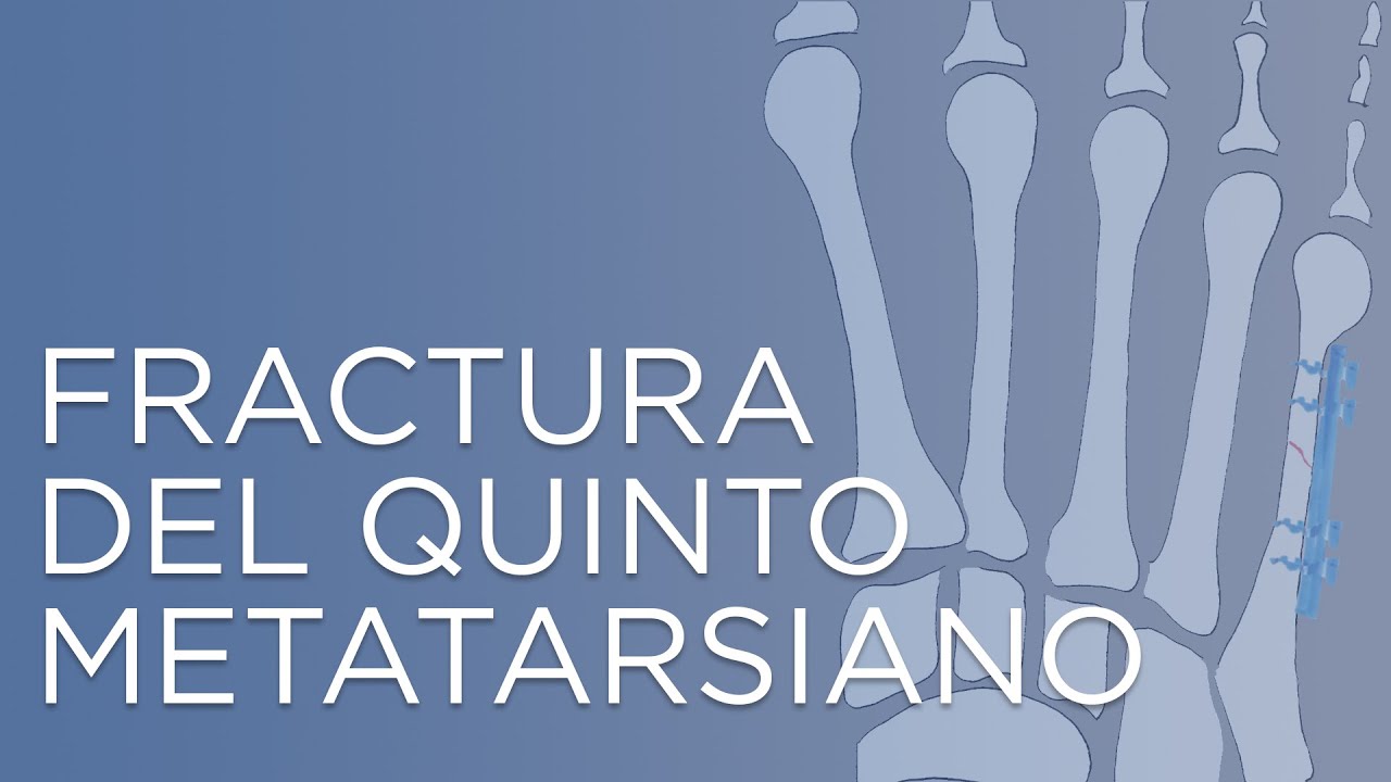 cuanto tarda en curar fractura metacarpiano
