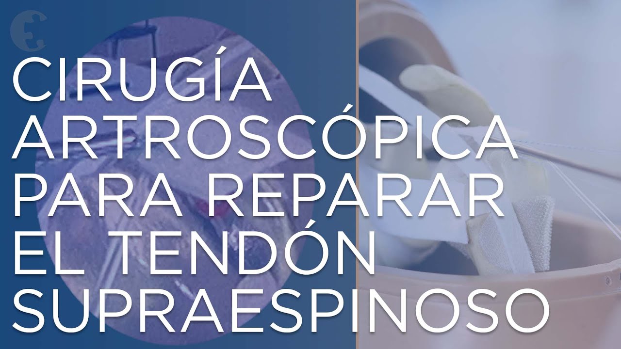 desgarro de grosor completo del tendon supraespinoso