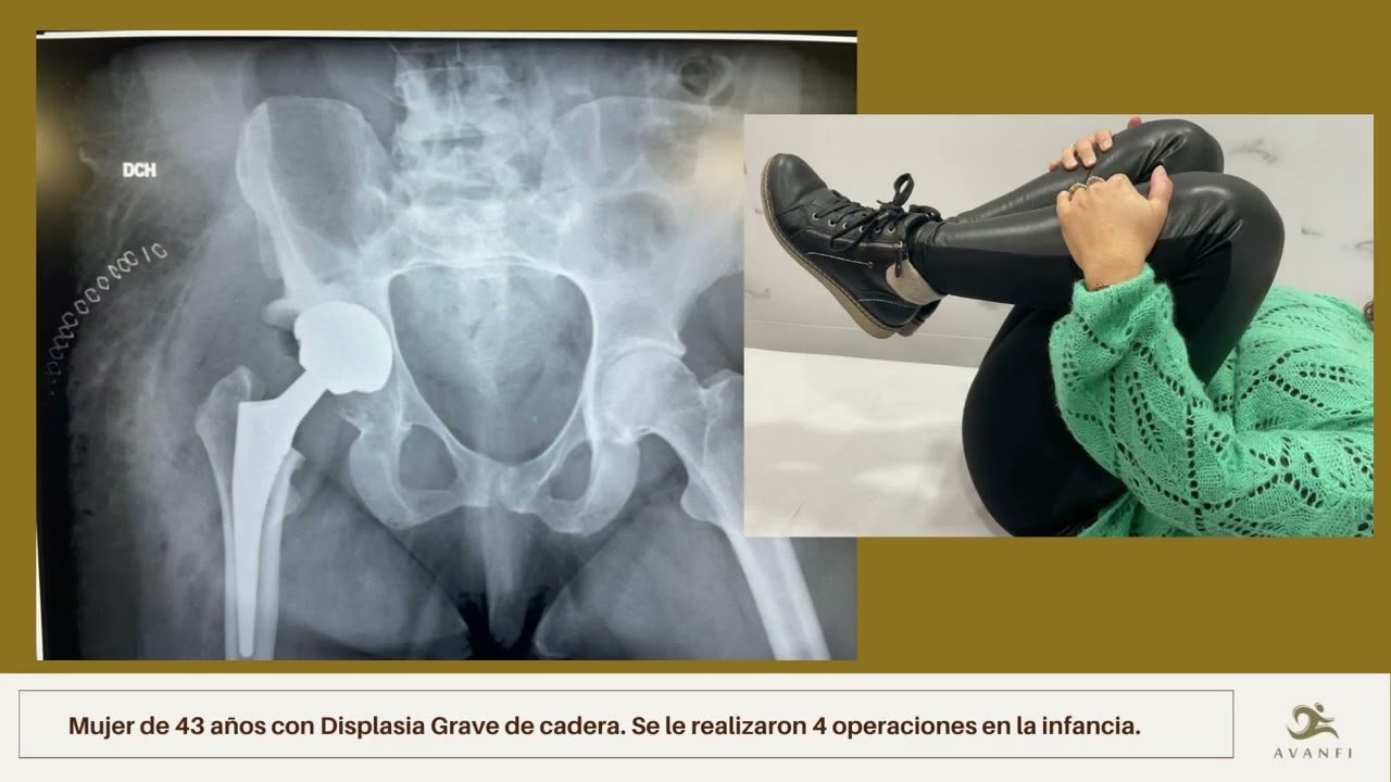 luxacion congenita de cadera en adultos