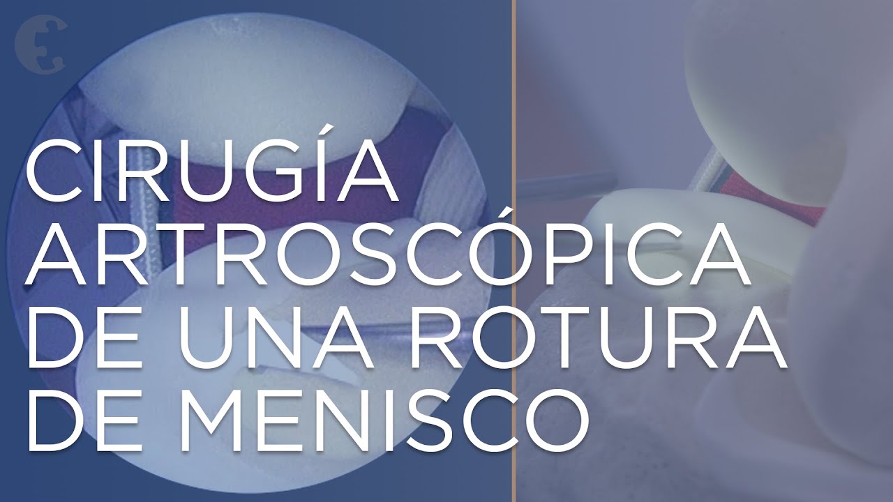 meniscectomía parcial del cuerno posterior del menisco interno