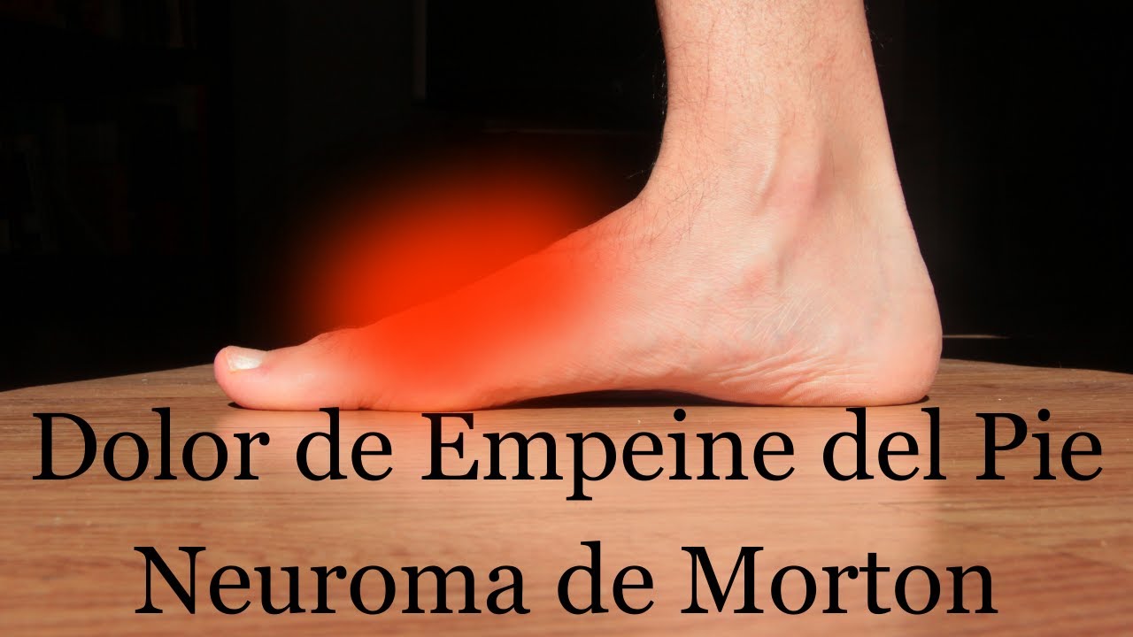 moreton en el empeine del pie