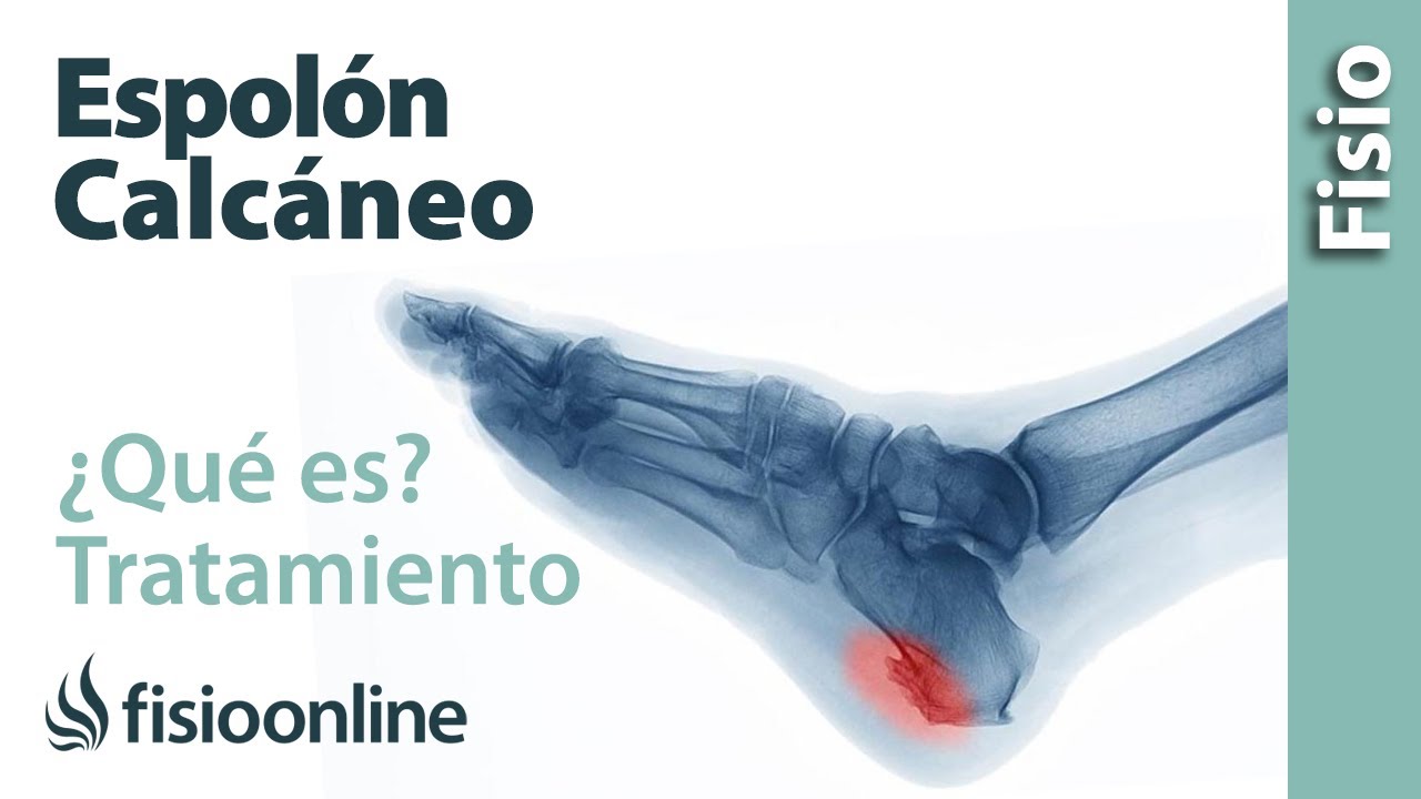 porque salen los espolones en los talones