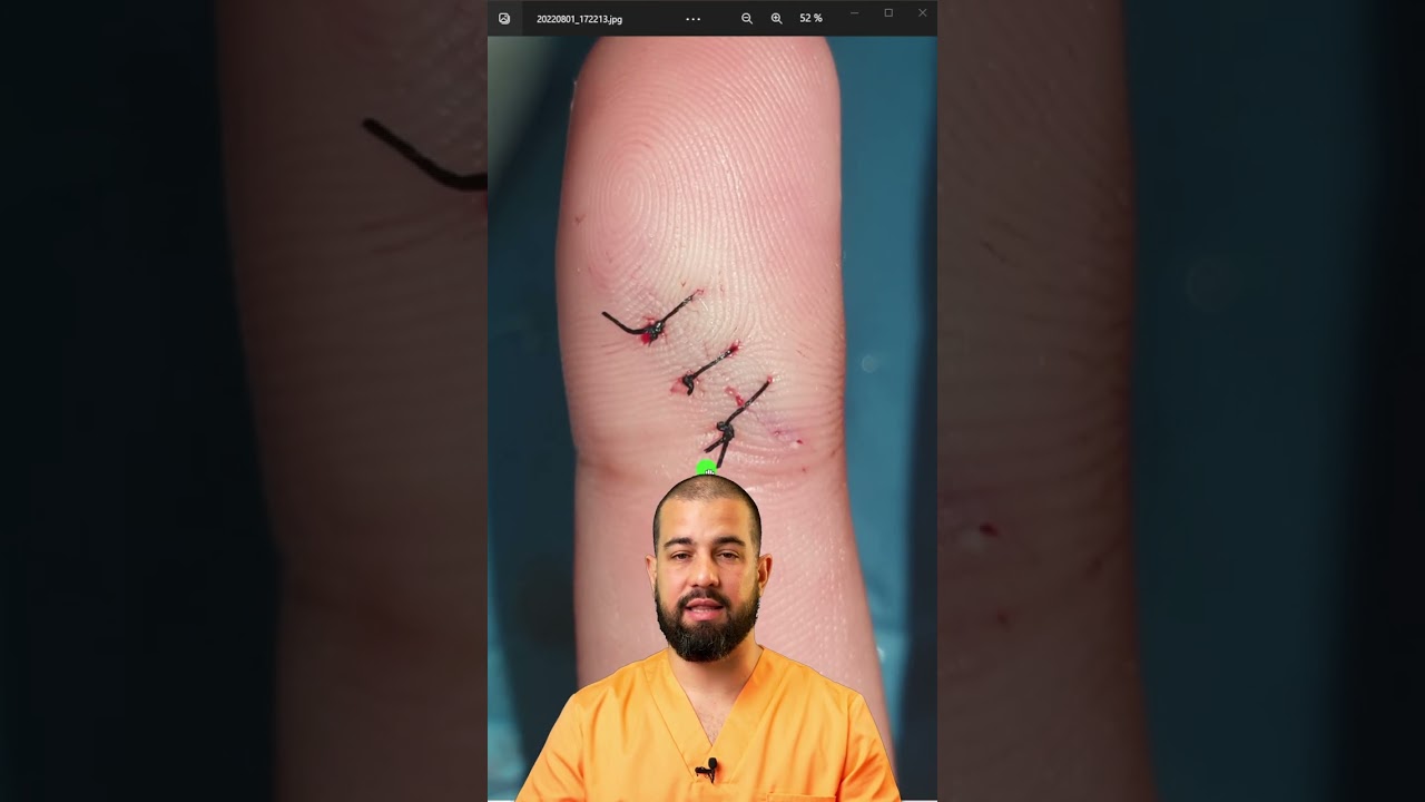 puntos de sutura en dedos dela mano