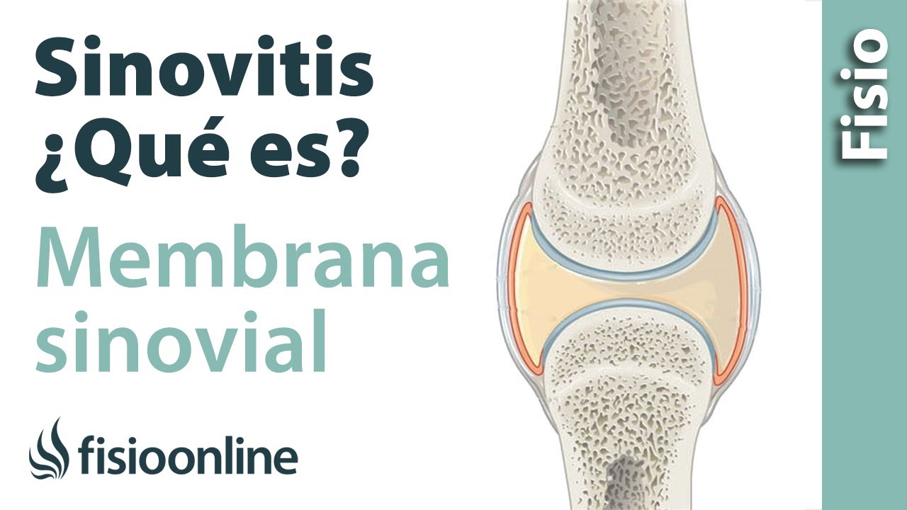 que es la sinovitis en las manos