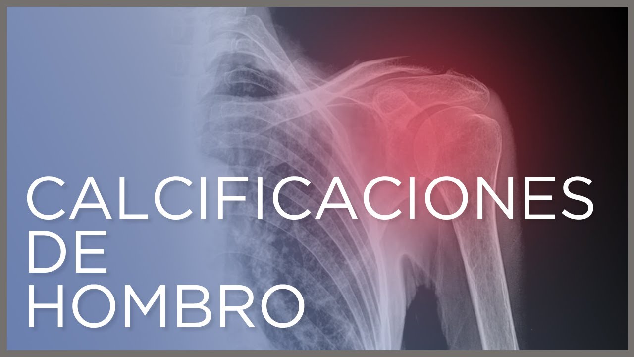 que es una calcificación en el hombro