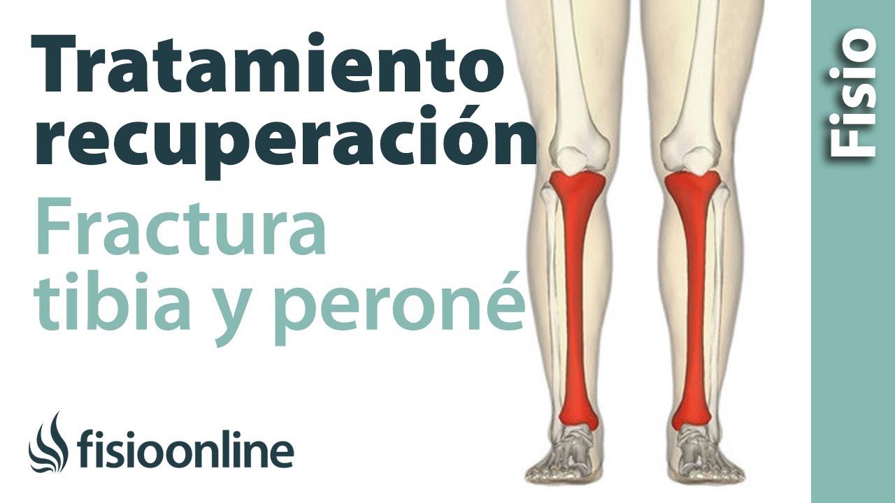 rehabilitación fractura de tibia y peroné con clavo intramedular