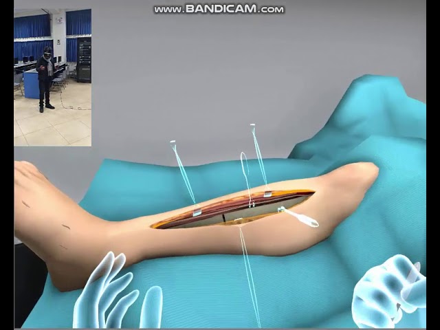 rotura de tibia y perone operacion