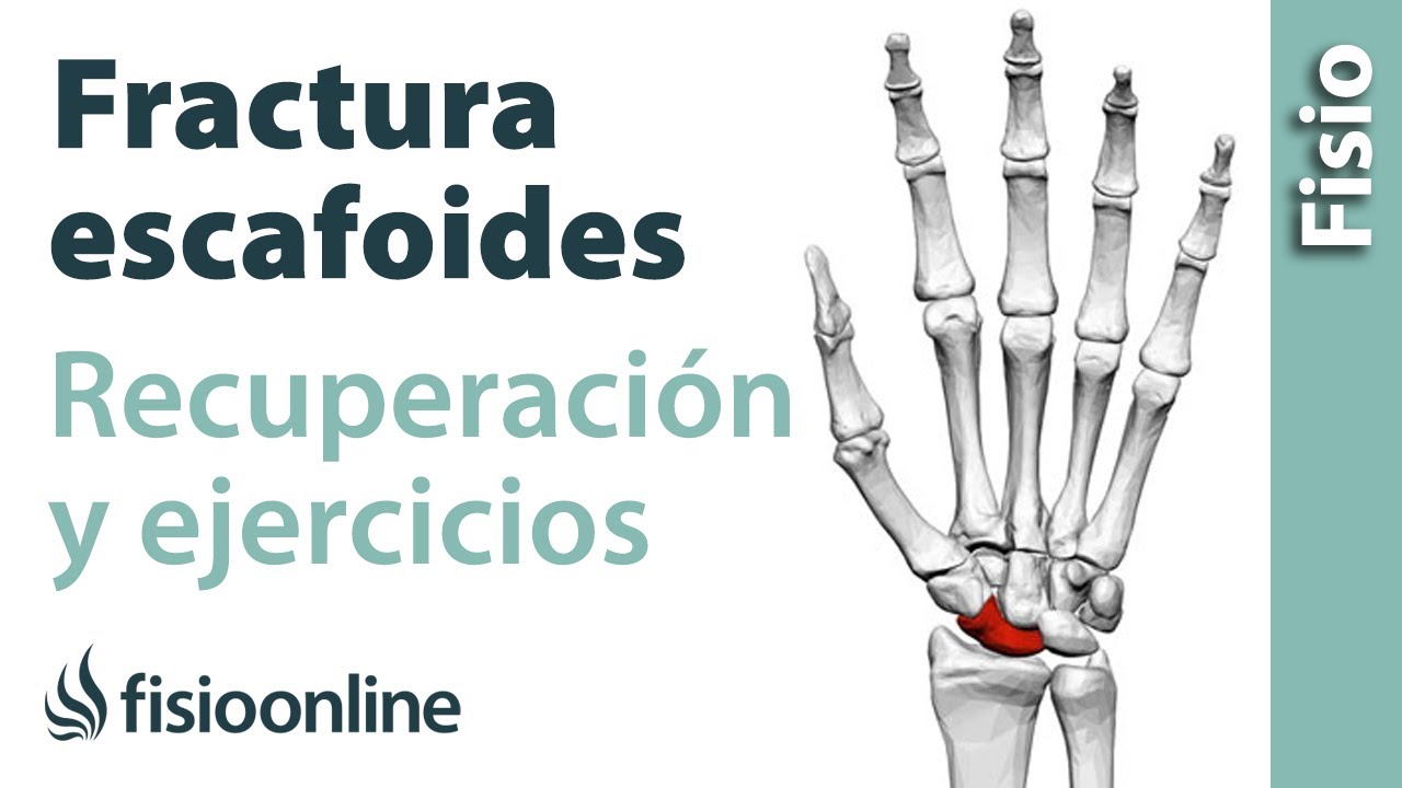 tiempo de baja por fractura de escafoides